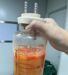 临邑水动力吸脂手术要做多久？